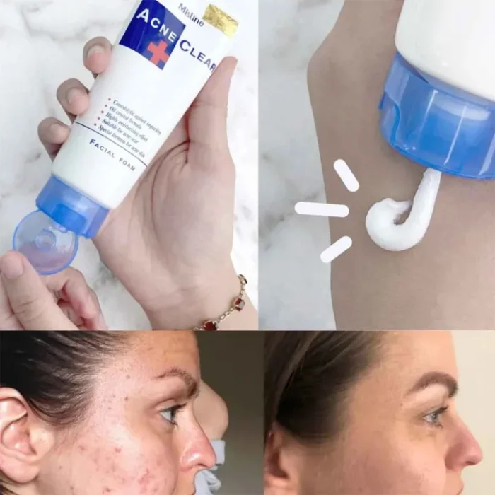 Acne Clear Facial Foam Face Wash